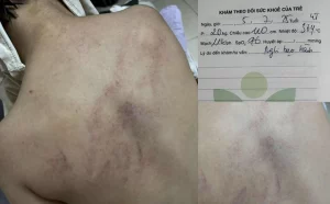 Bé Gái 4 Tuổi Bị Đánh Bầm Tím Sau Giờ Học: Hai Giáo Viên Bị Đình Chỉ