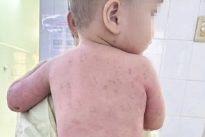 Mẹ hiến da cứu con trai 2 tuổi bỏng nặng 60% cơ thể